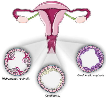 Vaginoza bacteriana: cauze, simptome si tratament